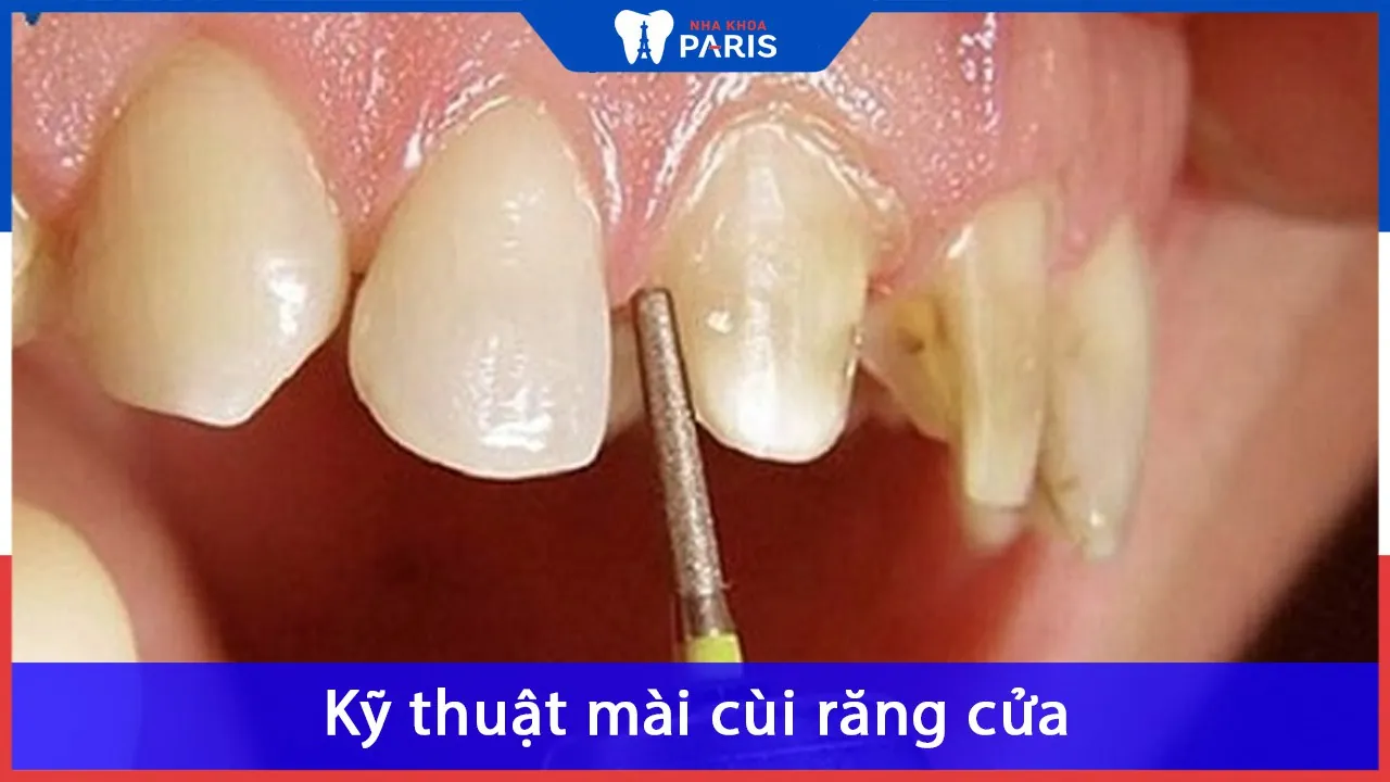 Mài cùi răng gì? có ảnh hưởng gì không? các bước mài cùi răng
