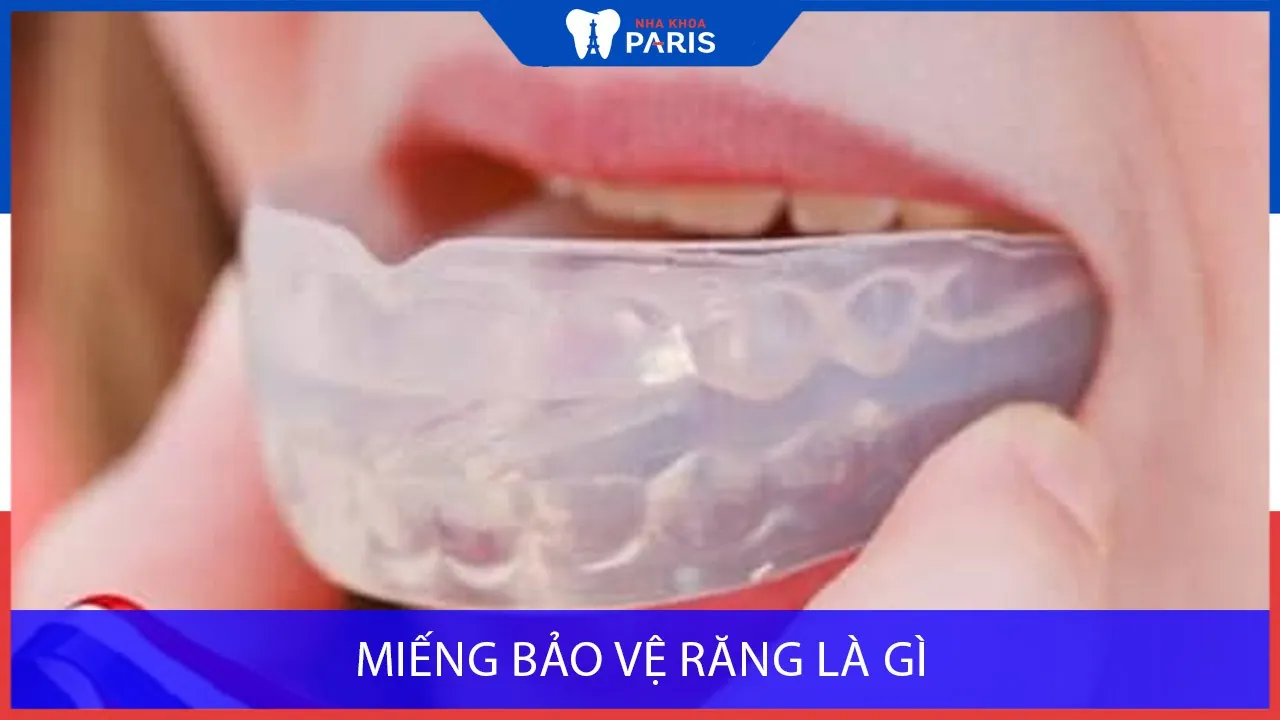 Miếng bảo vệ răng là gì? Có tác dụng gì? Giá bao nhiêu? Mua ở đâu?
