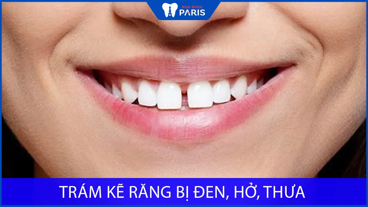 Trám kẽ răng bị đen, hở, thưa có nên hay không? Bác sĩ giải đáp