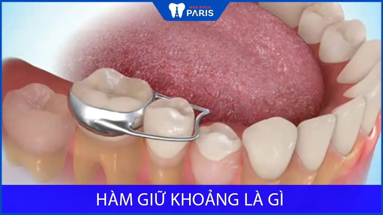 Hàm giữ khoảng là gì? Có mấy loại? Giá bao nhiêu tiền?