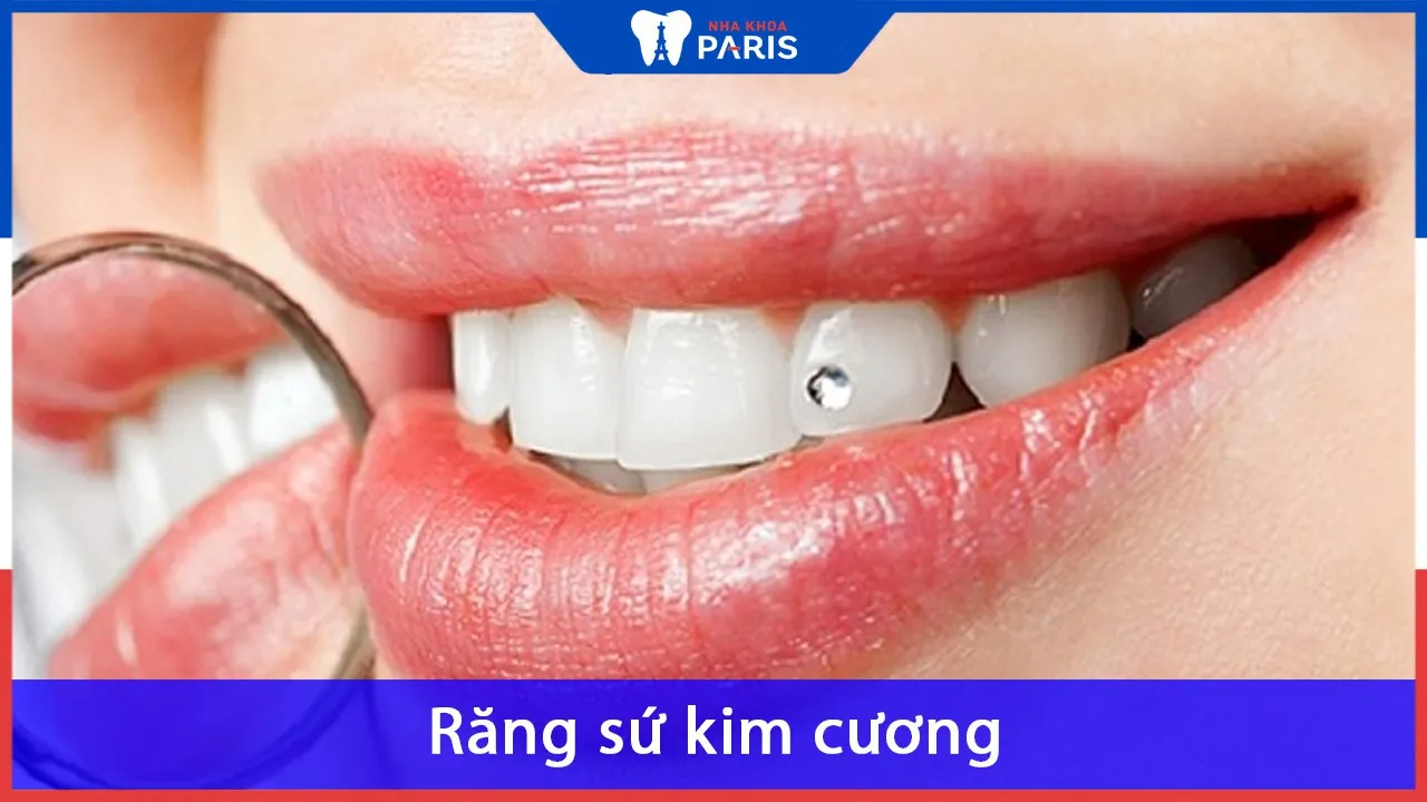 Răng sứ Kim cương: Ưu điểm nổi bật, Giá răng sứ Diamond