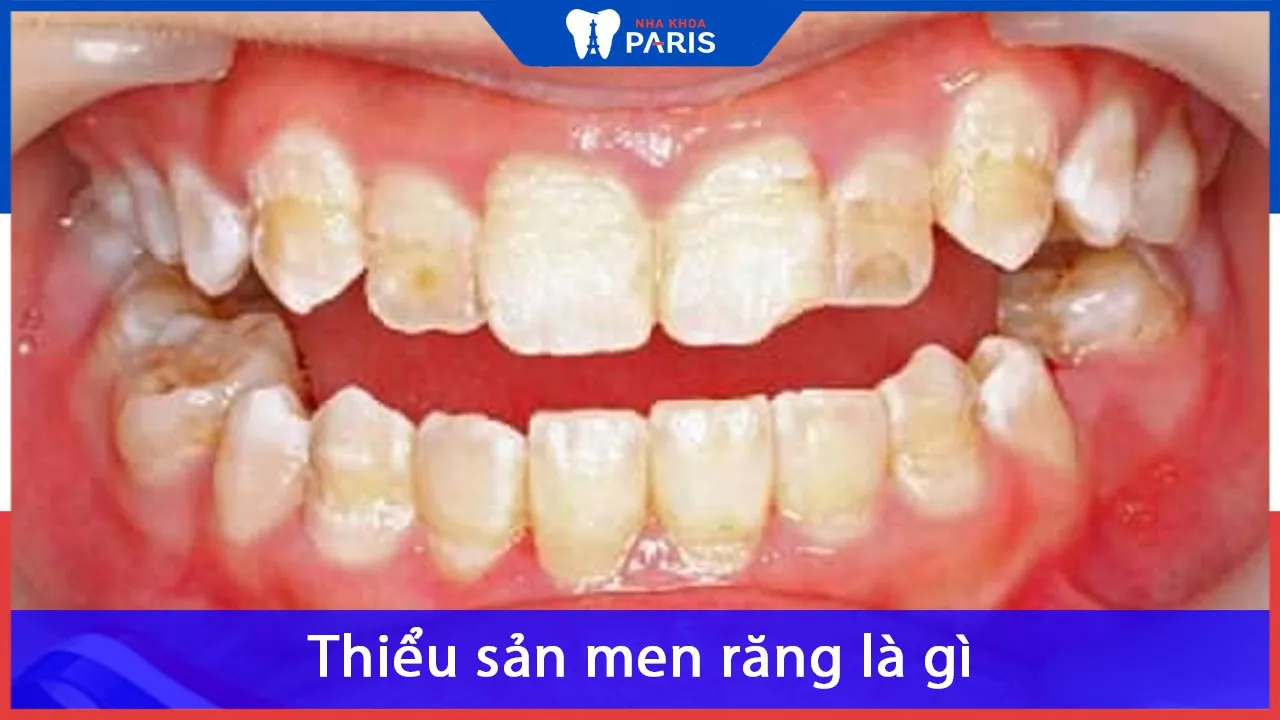Thiểu sản men răng là gì? Có nguy hiểm không? Chữa thế nào?