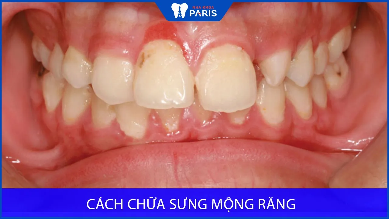 Cách chữa sưng mộng răng hiệu quả tại nhà và phòng nha cho bạn