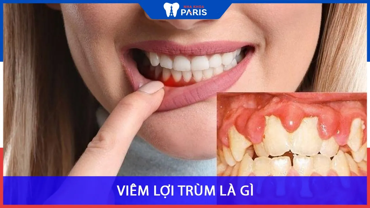 Viêm lợi trùm là gì? Có nguy hiểm không và cách chữa