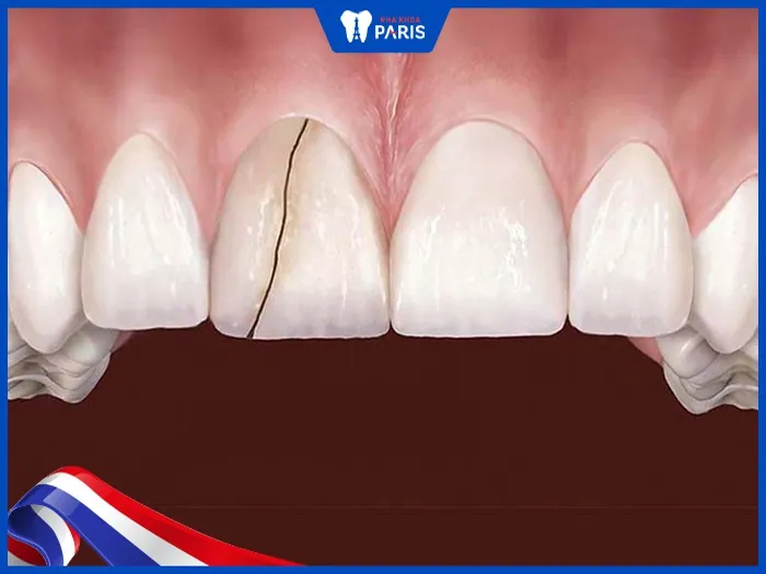 Răng bị nứt có tự lành được không | Nhận biết và cách xử lý