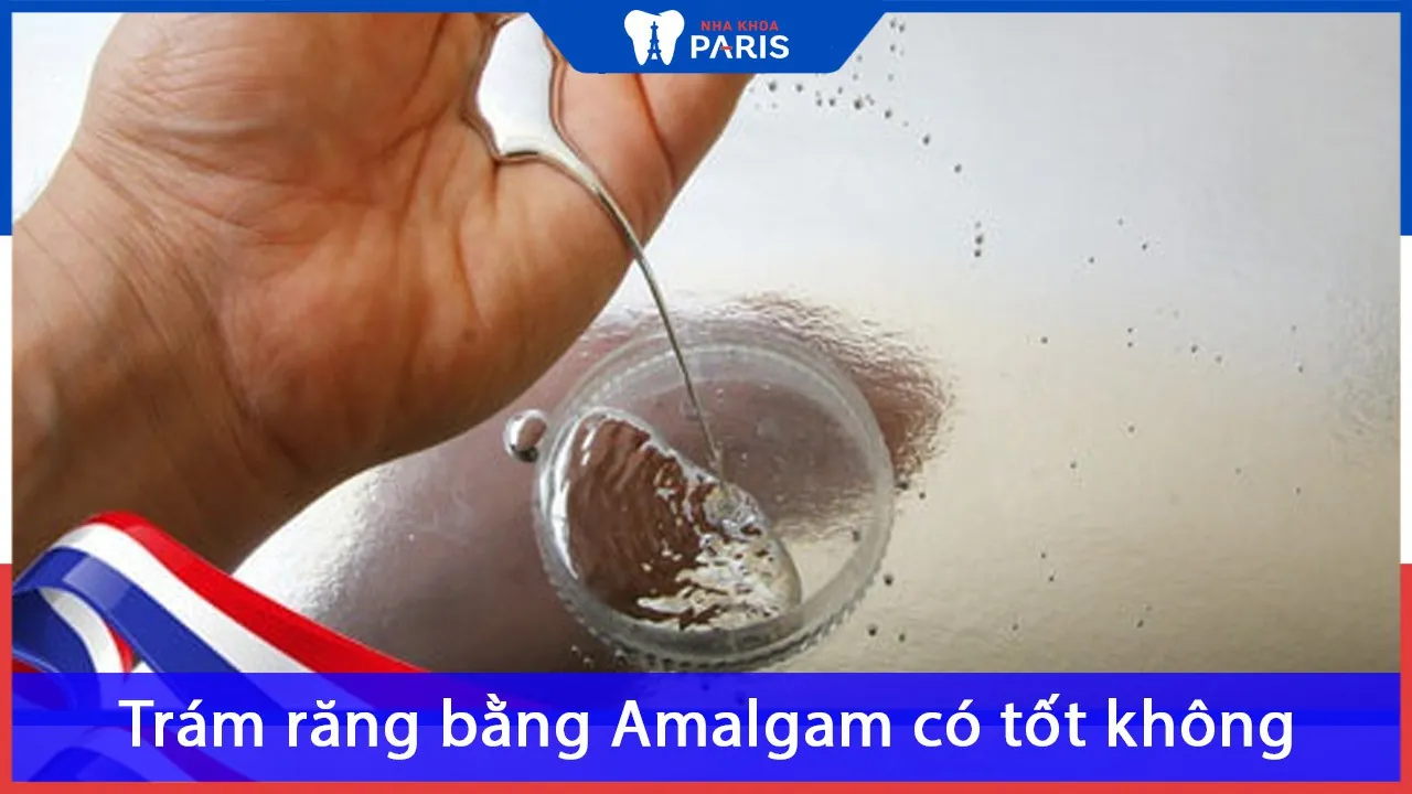 Amalgam là gì? Trám răng bằng Amalgam có tốt không?