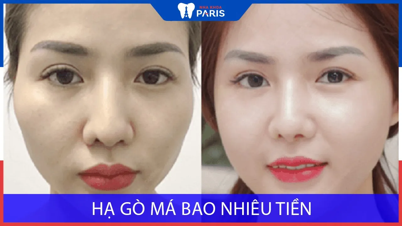 Phẫu thuật hạ gò má bao nhiêu tiền? Bảng giá mới 2025
