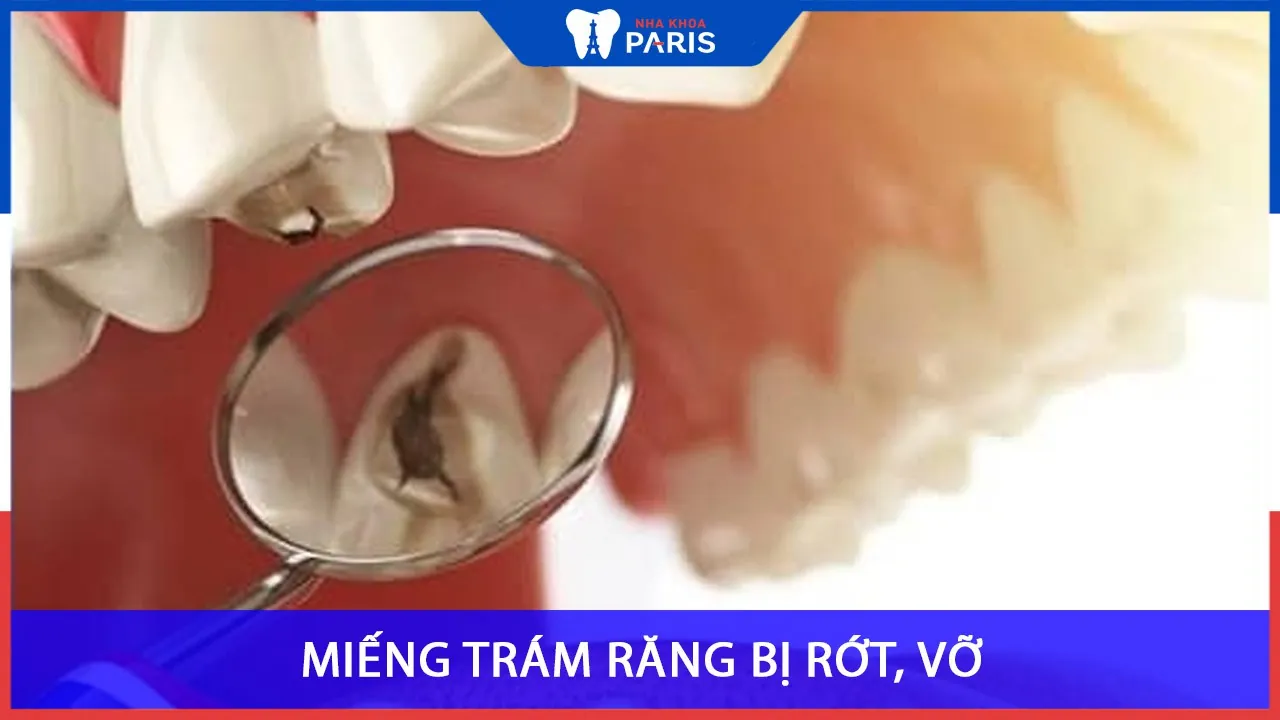 Miếng trám răng bị vỡ, rớt không trám lại có sao không?