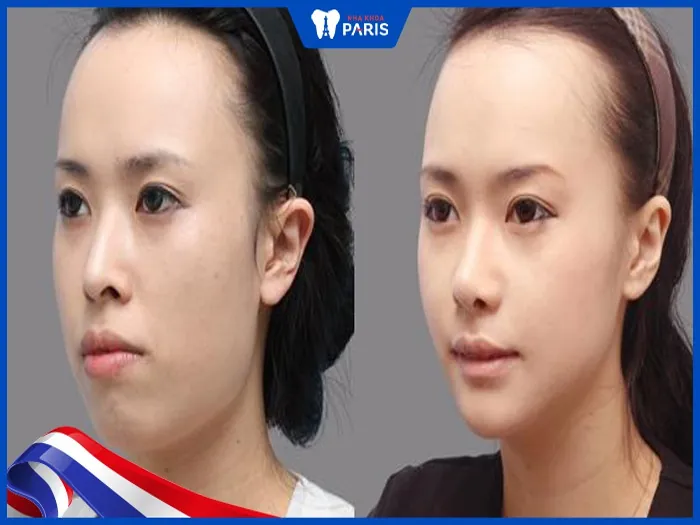 Giải đáp: Phẫu thuật hàm hô bao lâu thì lành và hết sưng?