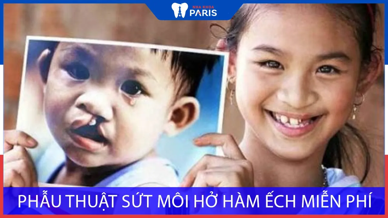 Chương trình phẫu thuật sứt môi hở hàm ếch Miễn Phí