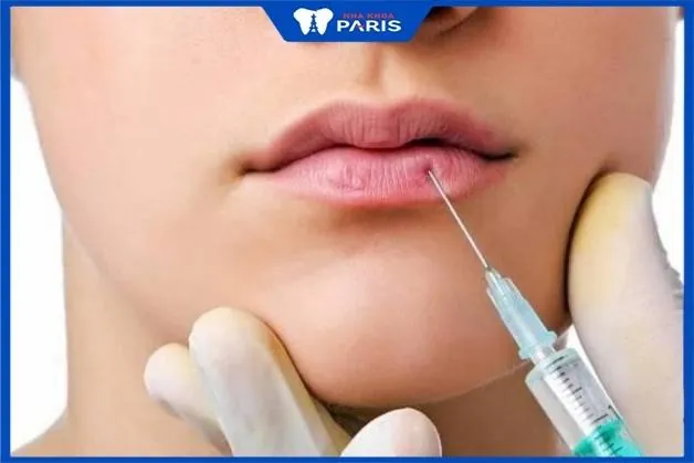 Tiêm filler môi sưng mấy ngày? Bao lâu thì Mềm, Đẹp & Ổn Định?