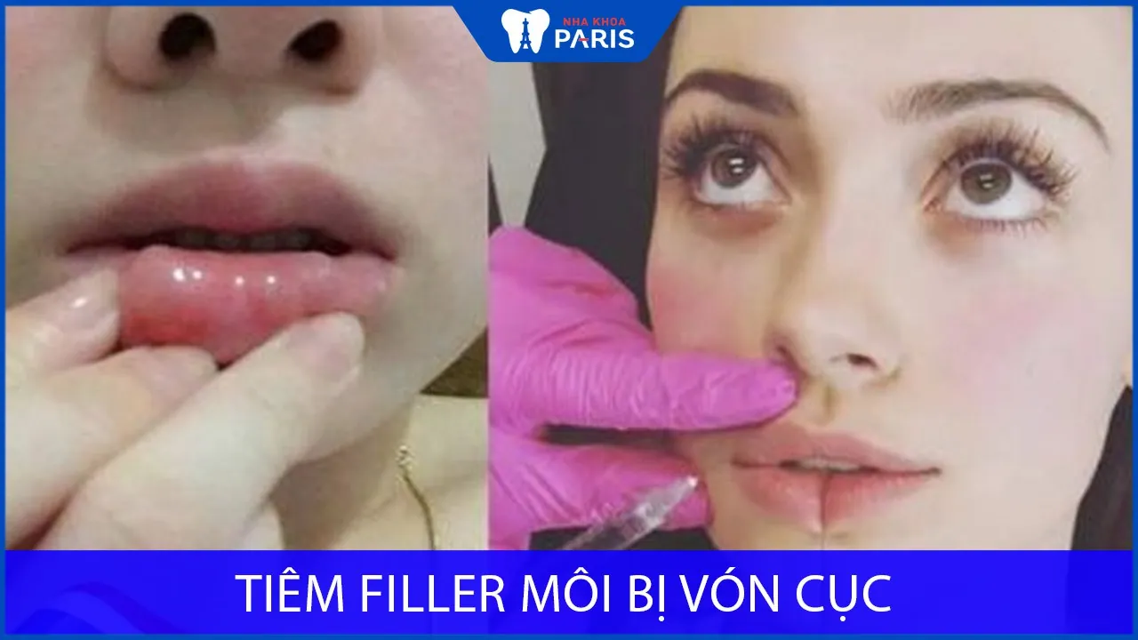 Tiêm filler môi bị vón cục có sao không? Nguyên nhân do đâu?