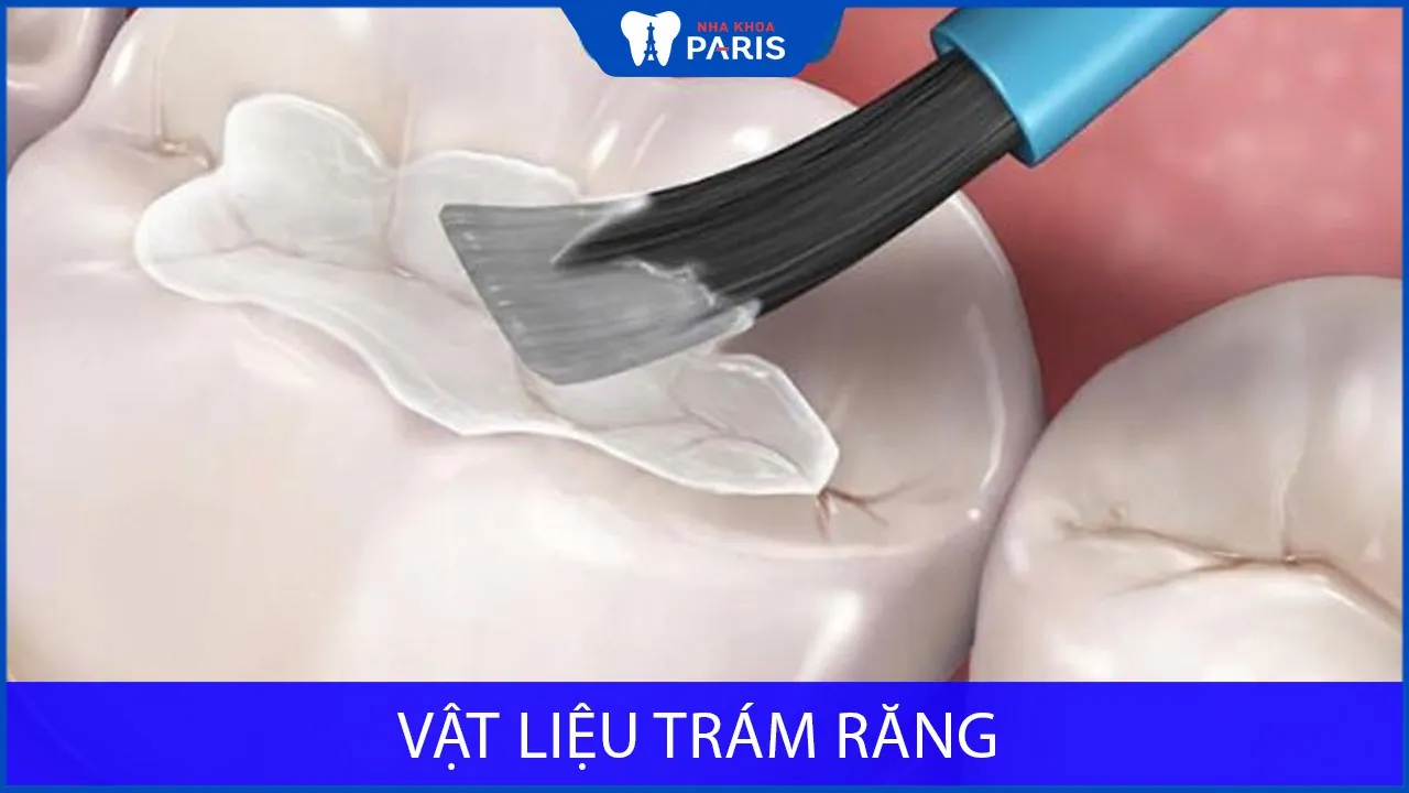 Tổng hợp 7 loại vật liệu trám răng đang được sử dụng phổ biến