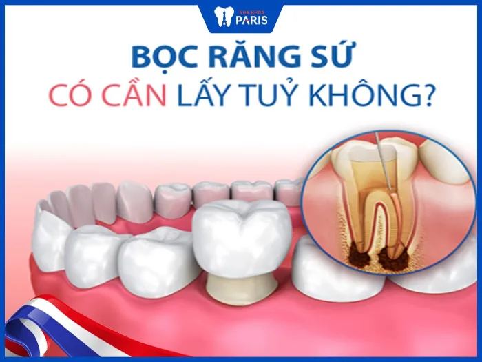 Giải đáp: Bọc răng sứ có cần lấy tủy răng không