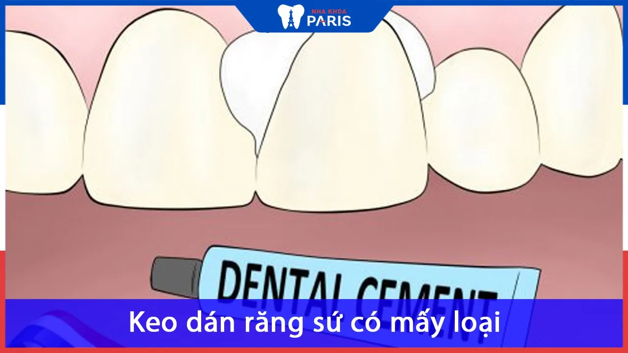 Keo dán răng sứ có mấy loại? Giá bao nhiêu? Mua ở đâu?