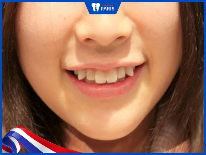Răng hổ ở người: Xem tướng răng đoán vẫn mệnh tính cách