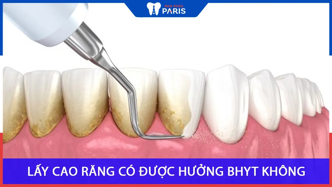 Lấy cao răng có được hưởng bảo hiểm y tế không?