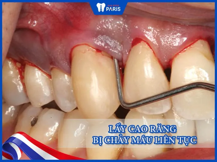 Lấy cao răng xong bị chảy máu liên tục: Cách khắc phục