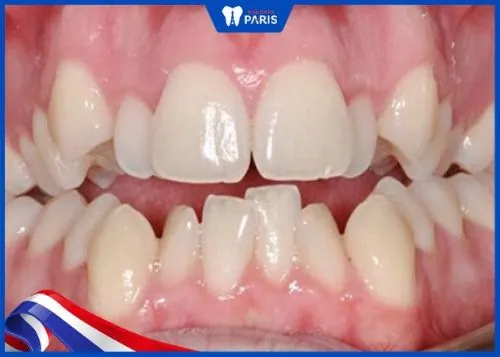 Răng 9630 là gì? Có ý nghĩa gì trong tướng số? Khắc phục thế nào?
