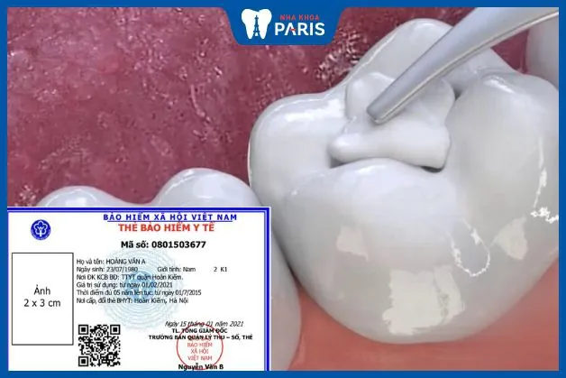 Trám răng có được hưởng bảo hiểm y tế không?bác sĩ nha khoa tư vấn
