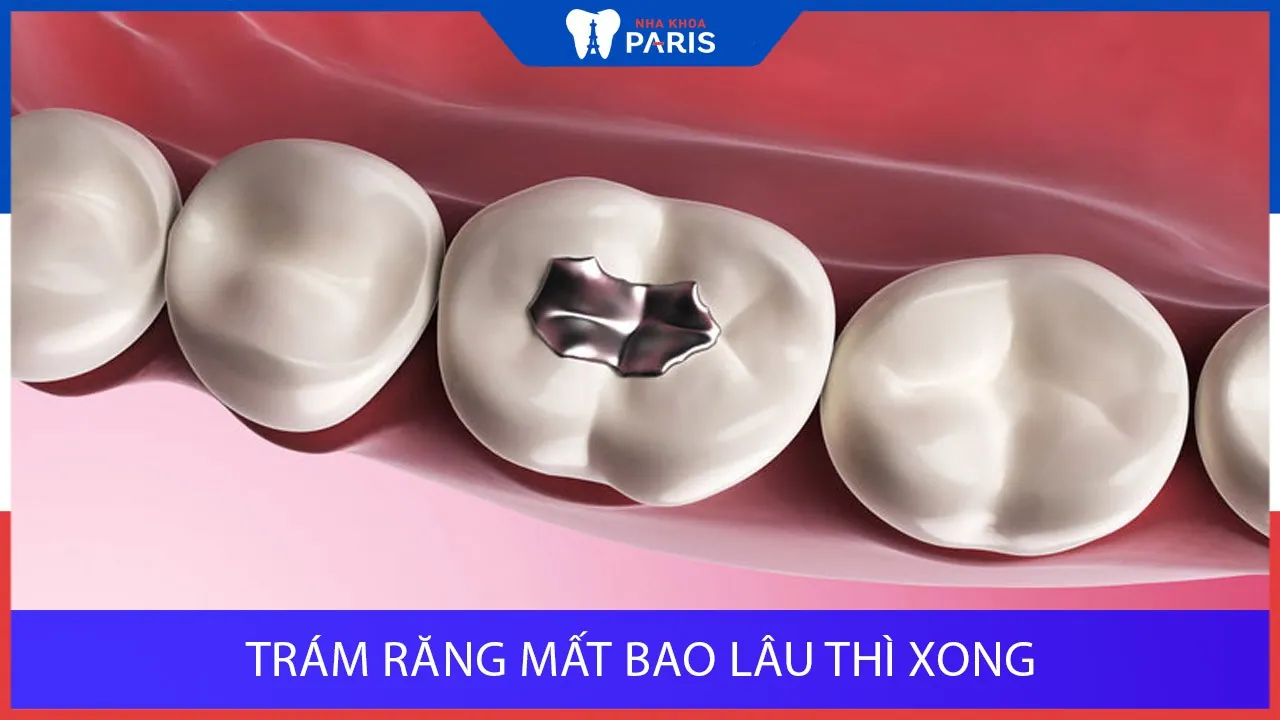 Trám răng mất bao lâu thì xong? Lưu ý quan trọng