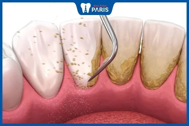 Lấy cao răng là gì? Có nên lấy cao răng không, Bác sĩ nha khoa giải đáp