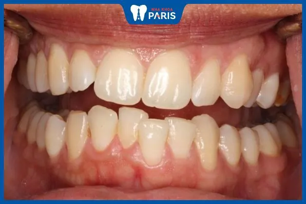 Bọc răng sứ cho răng khấp khểnh có được không? Chi phí là bao nhiêu?