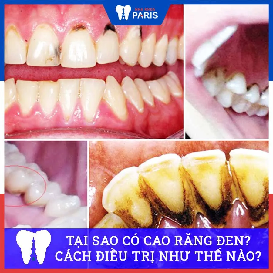 Cao răng đen: Nguyên nhân và cách khắc phục tình trạng