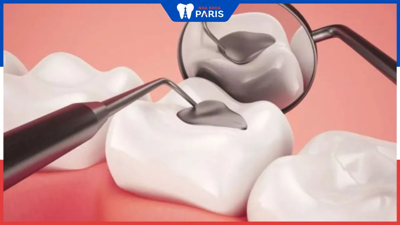 Mới trám răng có ăn được không? Nên ăn gì & kiêng gì tốt nhất?