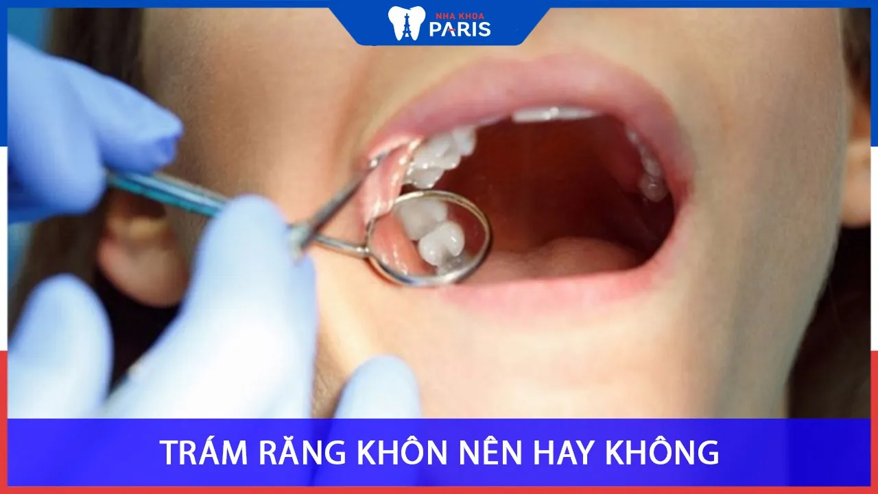 Trám răng khôn Nên hay Không? Giá bao nhiêu tiền?