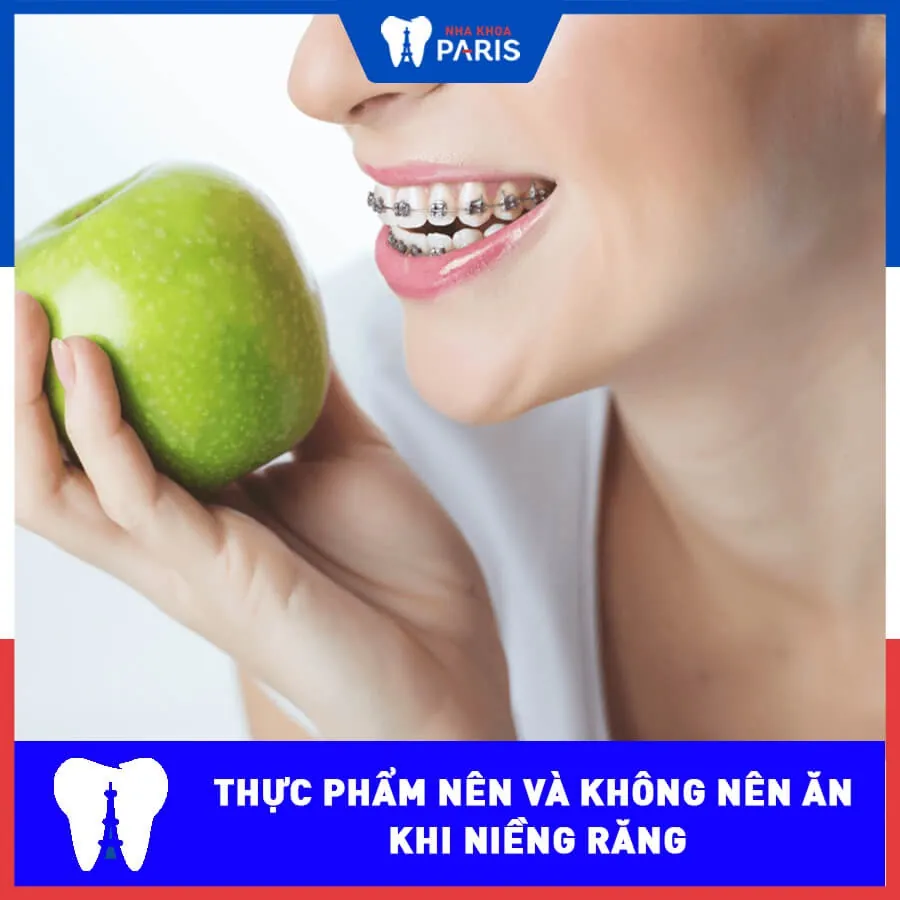 Những thực phẩm nên và không nên ăn khi niềng răng