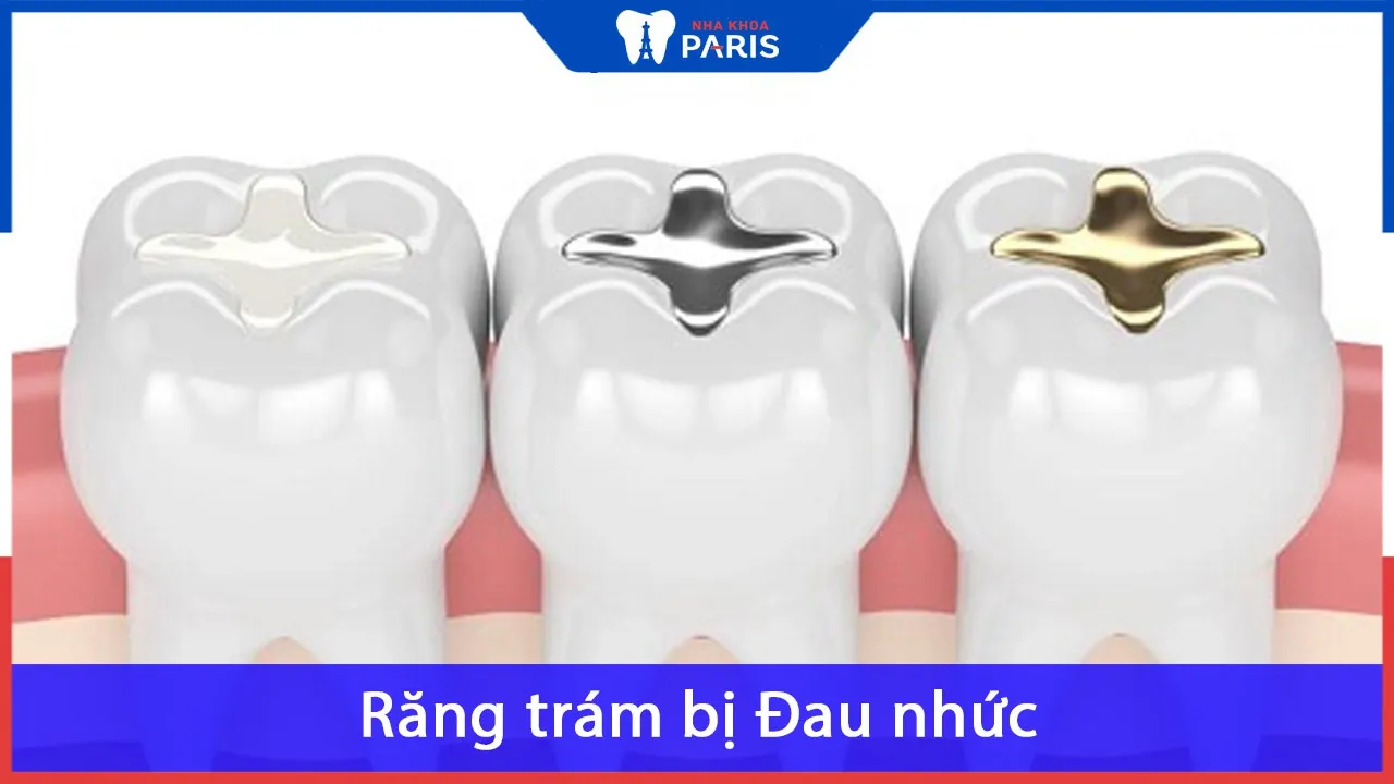 Răng trám bị Đau nhức, Ê Buốt: Nguyên nhân & Cách Điều Trị