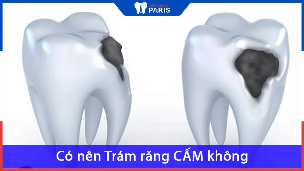 Có nên Trám răng CẤM không? Giá bao nhiêu tiền? Dùng vật liệu gì