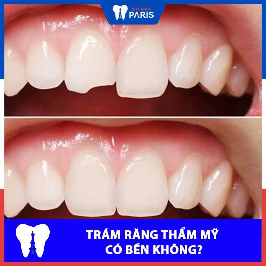Trám răng có bền không? Khi nào nên thực hiện trám răng