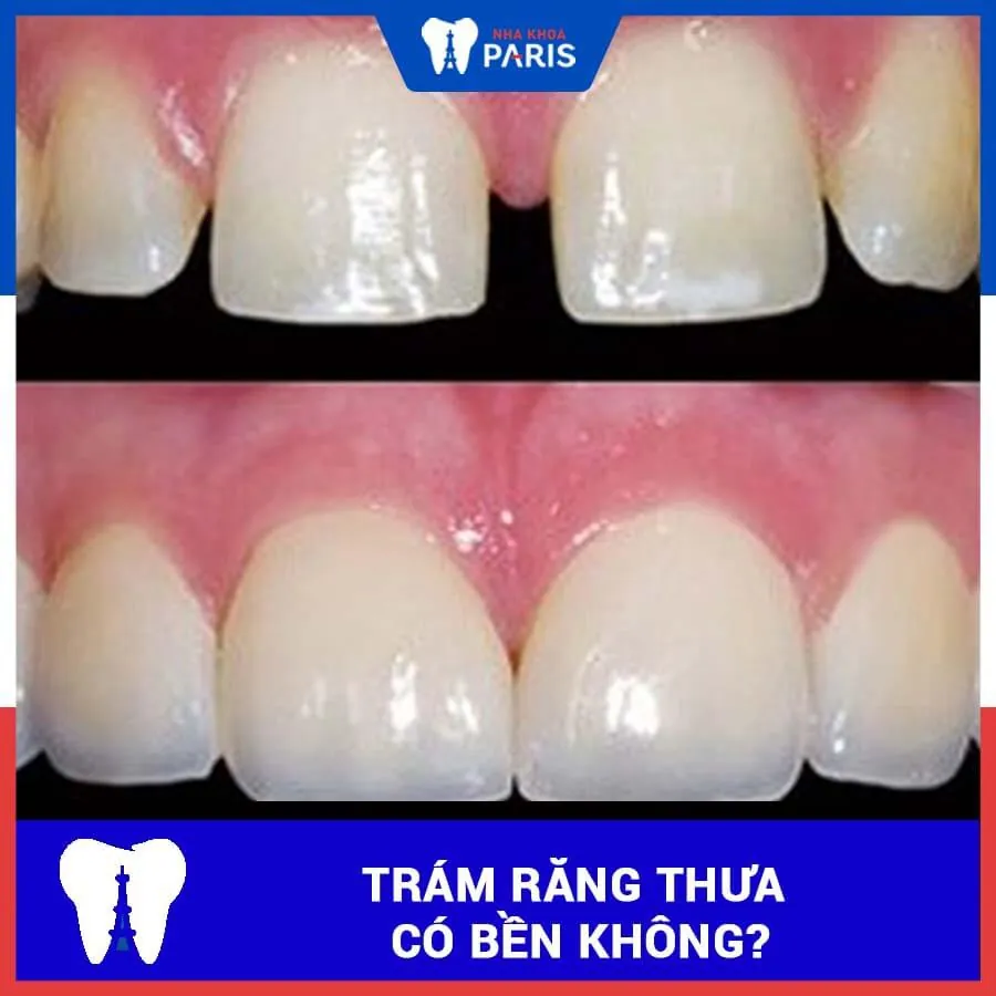 Trám răng thưa: Ưu điểm, chi phí và quy trình thực hiện