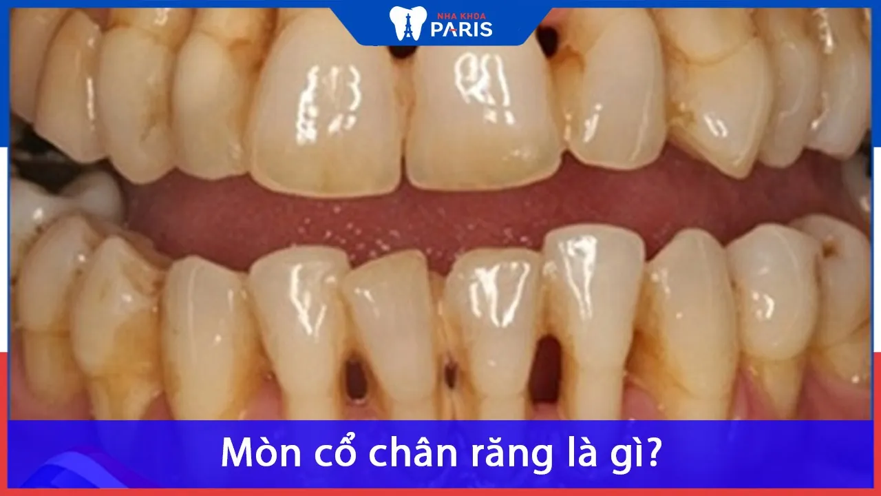 Mòn cổ chân răng xảy ra do đâu | Có nguy hiểm không