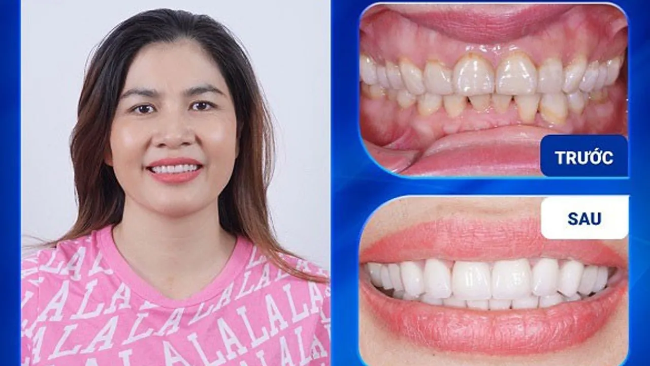 TOP 9 Nha Khoa Bọc Răng Sứ ở Bình Dương Tốt & Uy Tín Nhất