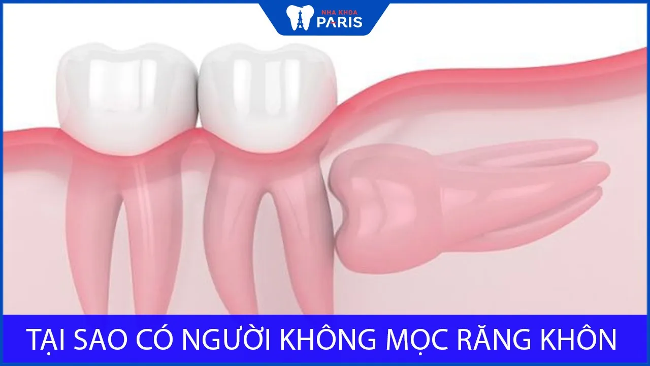 Tại sao có người không mọc răng khôn? Liệu có ảnh hưởng gì không?