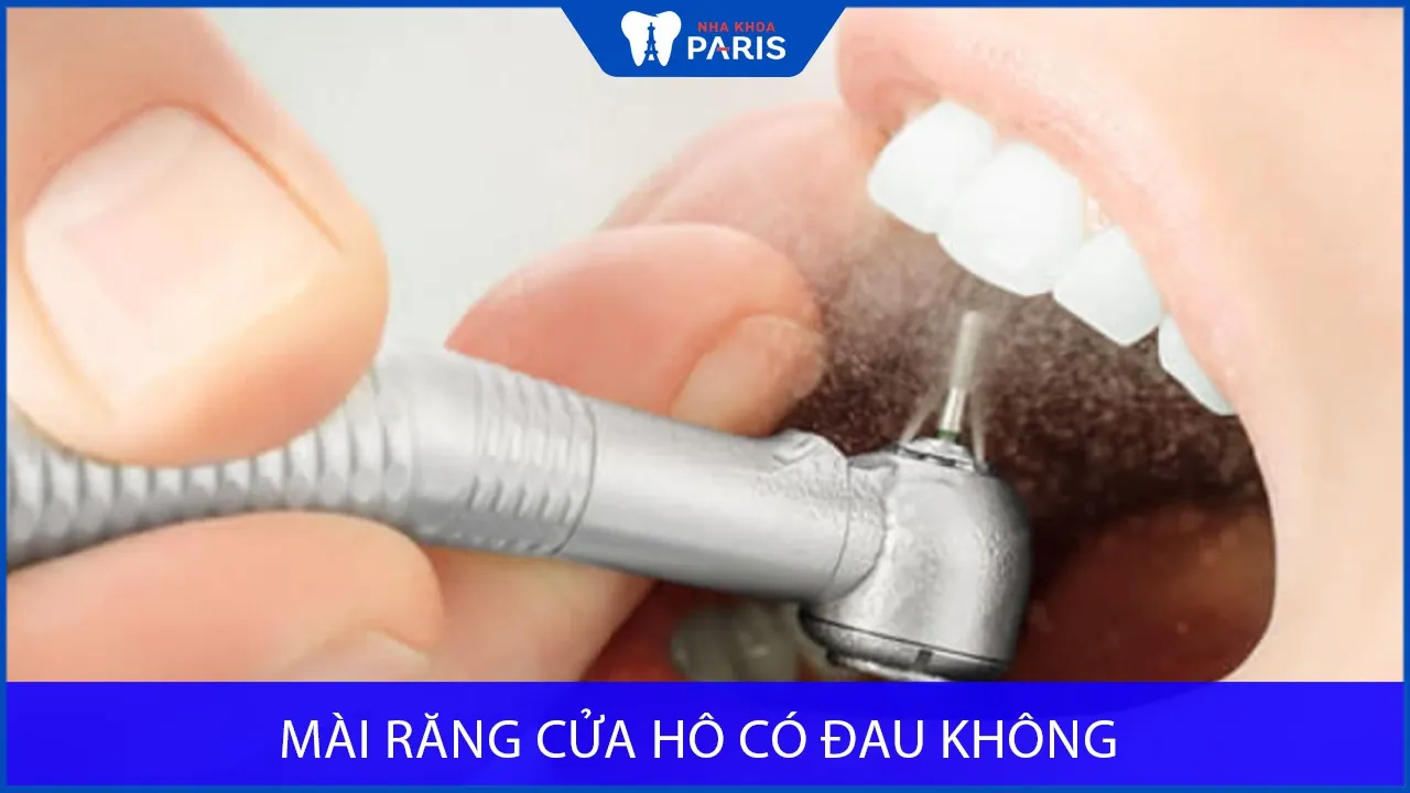 Mài răng cửa hô có Đau không? Điều trị tại Nha khoa Paris
