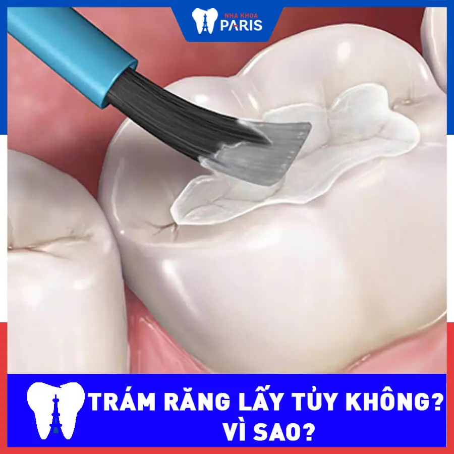 Trám răng có cần lấy tủy không, vì sao cần xử lý gấp