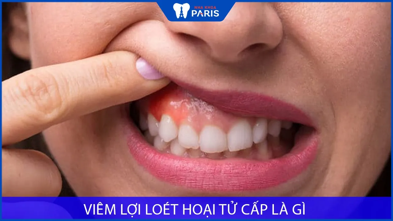 Viêm lợi loét hoại tử cấp là gì? Nguyên nhân & cách nhận biết