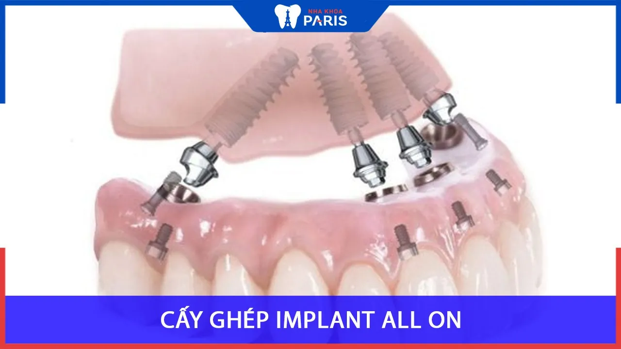 Cấy Ghép Implant All On 4, all on 6 toàn hàm, Giải pháp trồng răng