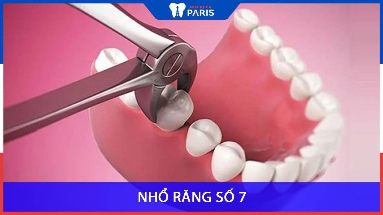 Nhổ răng số 7 và những thông tin quan trọng bạn không thể bỏ qua