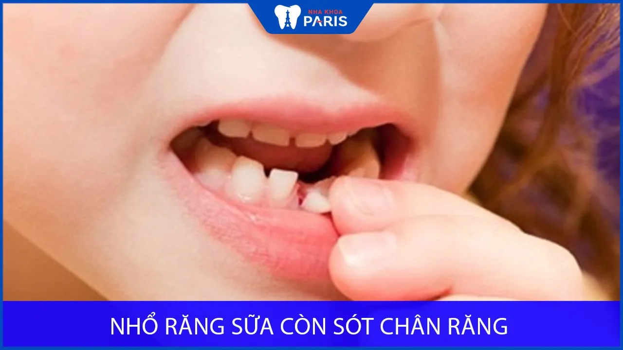 Nhổ răng sữa còn sót chân răng có sao không? Phải xử lý thế nào?
