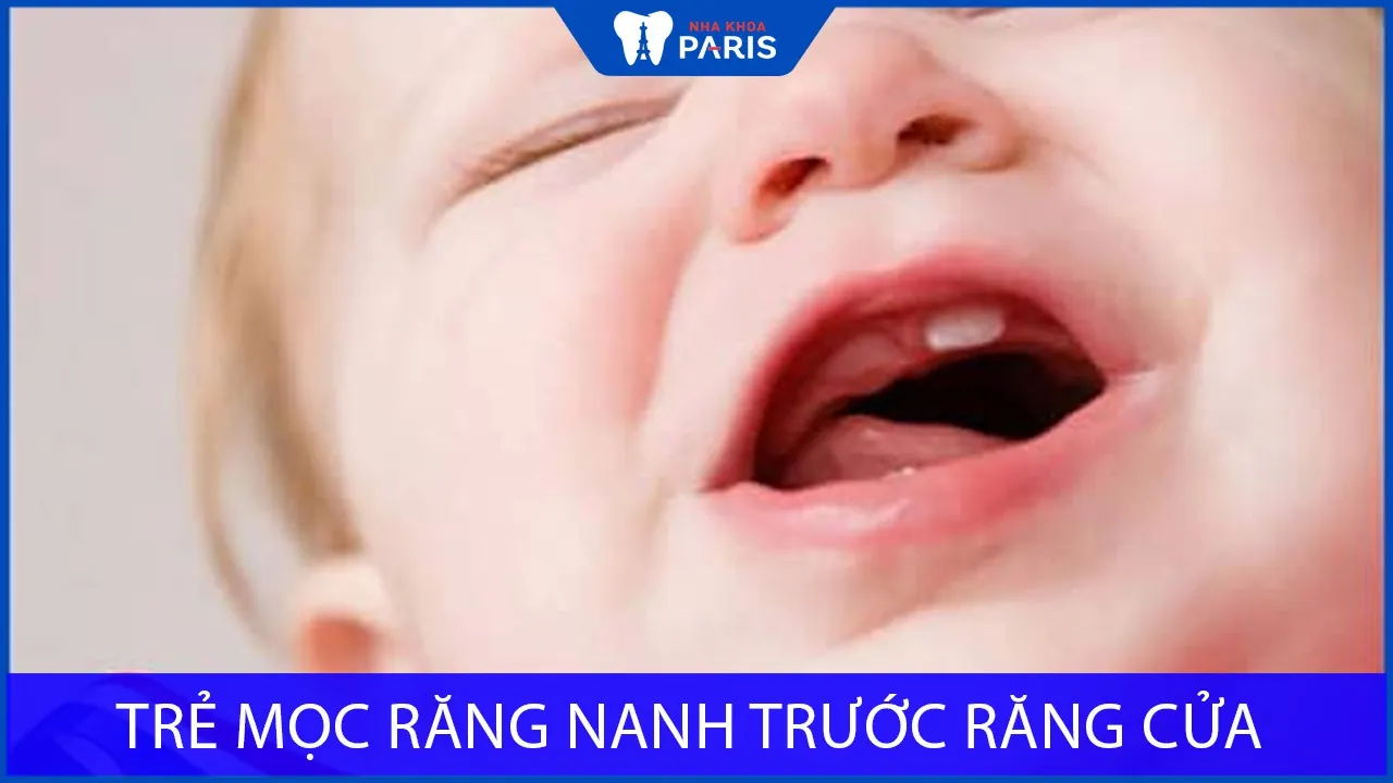 Trẻ mọc răng nanh trước răng cửa có sao không?