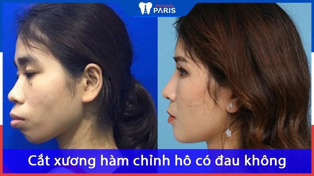 Giải mã câu hỏi: Cắt xương hàm chỉnh hô có đau không?