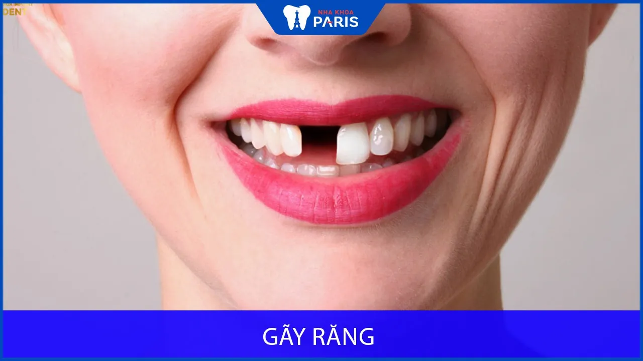 Răng bị gãy có mọc lại không? Phải làm sao khi bị gãy răng?