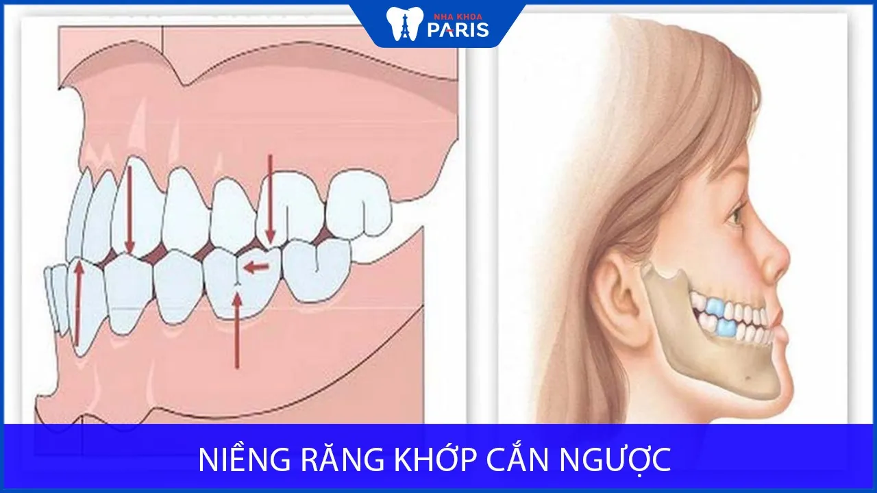 Niềng răng khớp cắn ngược dùng khí cụ gì? Hiệu quả ra sao?