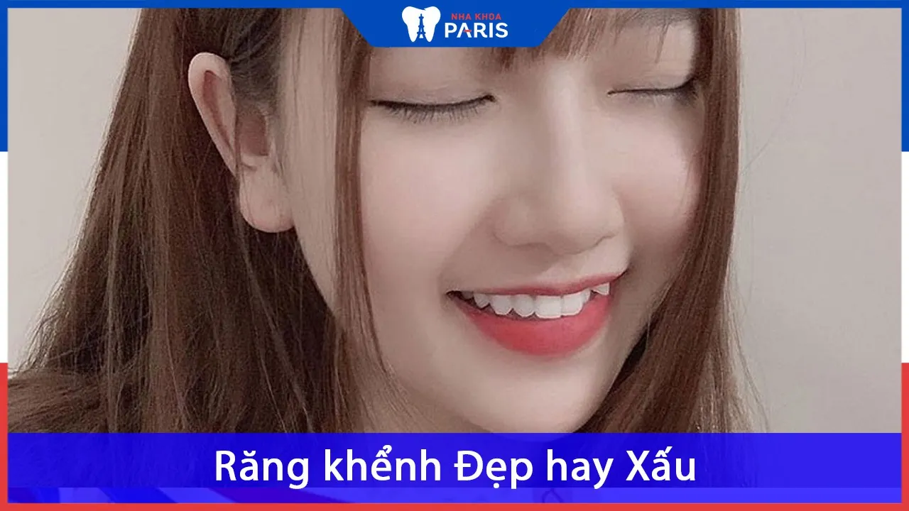 Răng khểnh là gì? Ý nghĩa của răng khểnh trong phong thủy