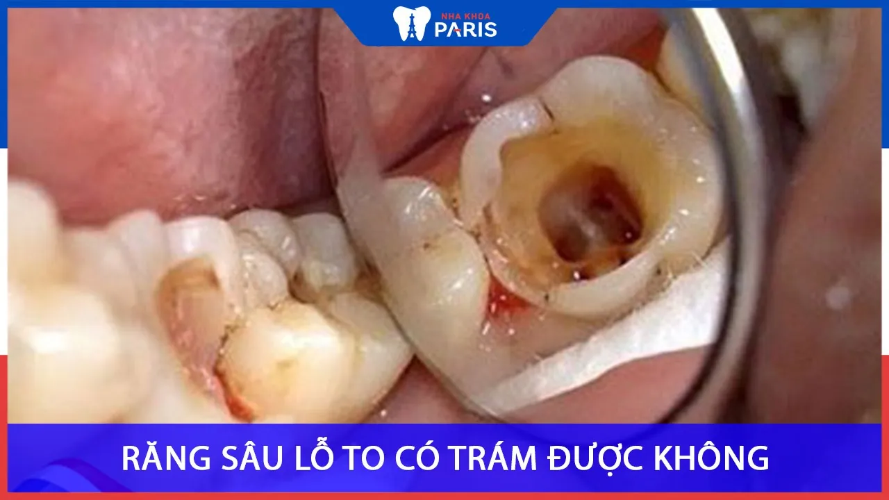 Răng sâu lỗ to là như thế nào? Tại sao nên bọc sứ cho răng sâu lỗ to
